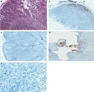 Pattern of sentinel lymph node positivity correlates with survival in Merkel cell carcinoma Pattern 1 Pattern 2 Among patients with lymph node involvement by MCC (H&E or IHC) What are the patterns of