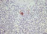 patients 23 SLNBs All negative on 1 st H&E IHC