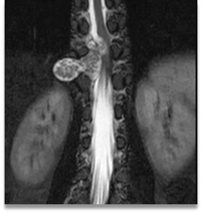 foramina, spinal canal, and thecal sac and spinal Image 3: T2 saggital showing heterogeneous cord.
