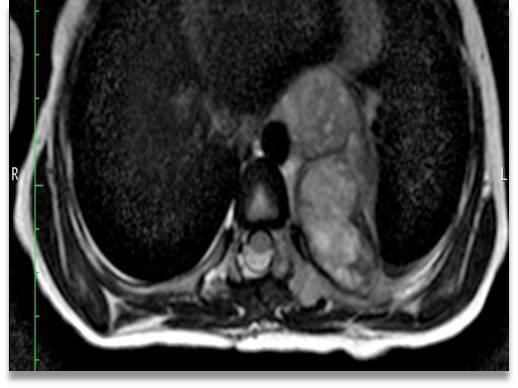 necrosis can be well detected with MRI.