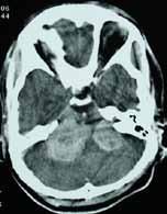 Non enhanced CT (NECT) and contrast enhanced CT (CECT) scan of the cranium [Fig.