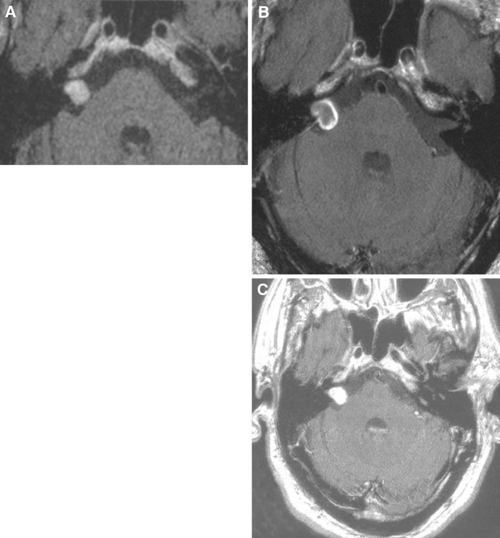 CHANG ET AL. nipaque contrast (iohexol, 350 mg I/ml; Nycomed, Inc., Princeton, NJ). The acquired images were transferred by network to the CyberKnife treatment planning workstation.