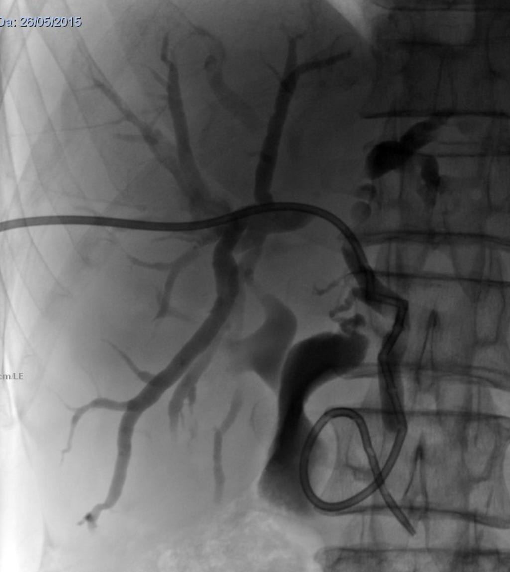 Fig. 7: External-inernal drainage: Gallstones upstream common hepatic duct obstruction Fig.