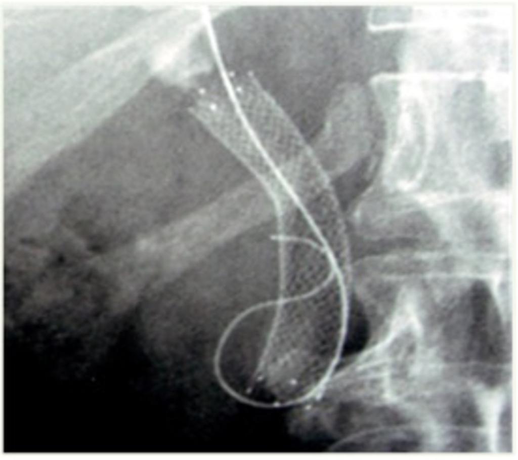 Fig. 12: Metal stent in the