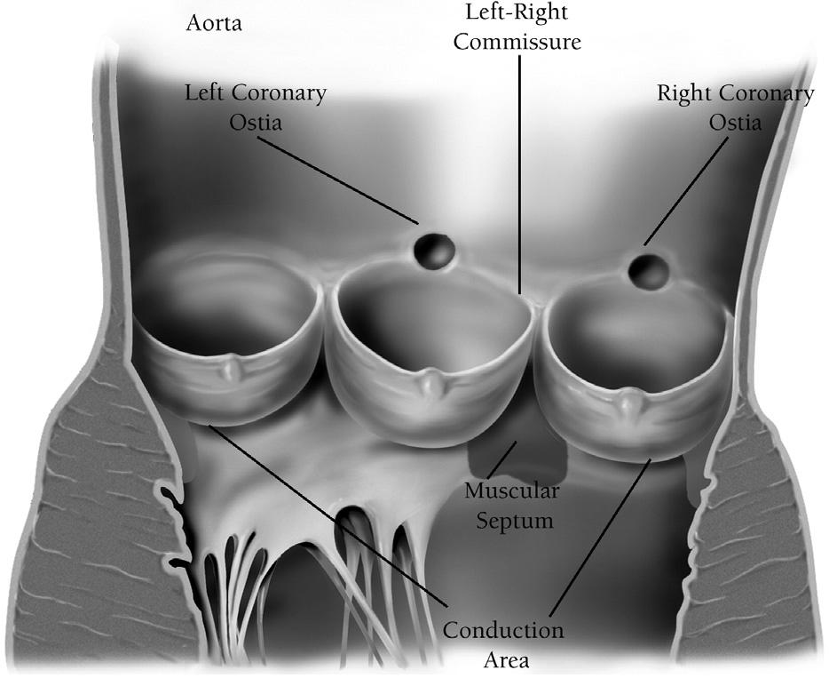 Figure 4 The anatomy of the patient s aortic valve must be defined after completely excising the diseased valve leaflets and debriding the annulus and aortic wall of calcium.