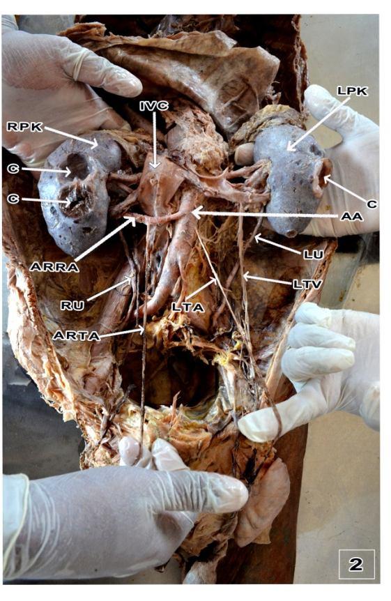 from abdominal aorta 30mm below the origin of aberrant left renal artery and 50mm from the origin of left renal artery. Both the renal veins and testicular veins maintained normal course.