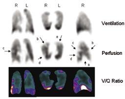 pe Interpretation Normal ventilation SPECT confirms the perfusion defect in the (a) anterobasal segment of the right lower lobe identified on planar imaging