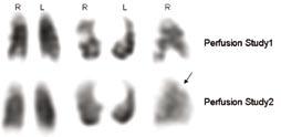anterobasal segment The scan unequivocally demonstrates multiple PE Reference 1.