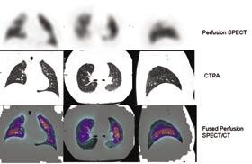 Case 3 CTPA performed 24hrs after V/Q Scan No discrete filling defects to suggest thromboembolism in the pulmonary trunk, main pulmonary arteries or segmental