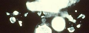 Case 8 V/Q SPECT-Imaging versus CTA for Pulmonary Thrombo-Embolism Michael Lemb Radiologist Gemeinschaftspraxis fuer Radiologie und Nuklearmedizin Bremerhaven Germany email: lemb-donnern@t-online.