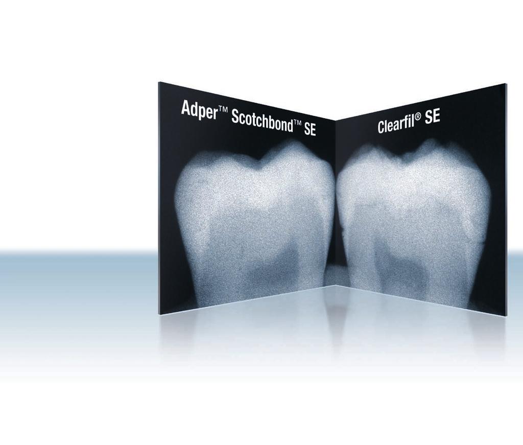 Radiopacity: be confident in your future diagnosis. One confidence-inspiring feature of Adper Scotchbond SE Self-Etch Adhesive is its radiopacity.