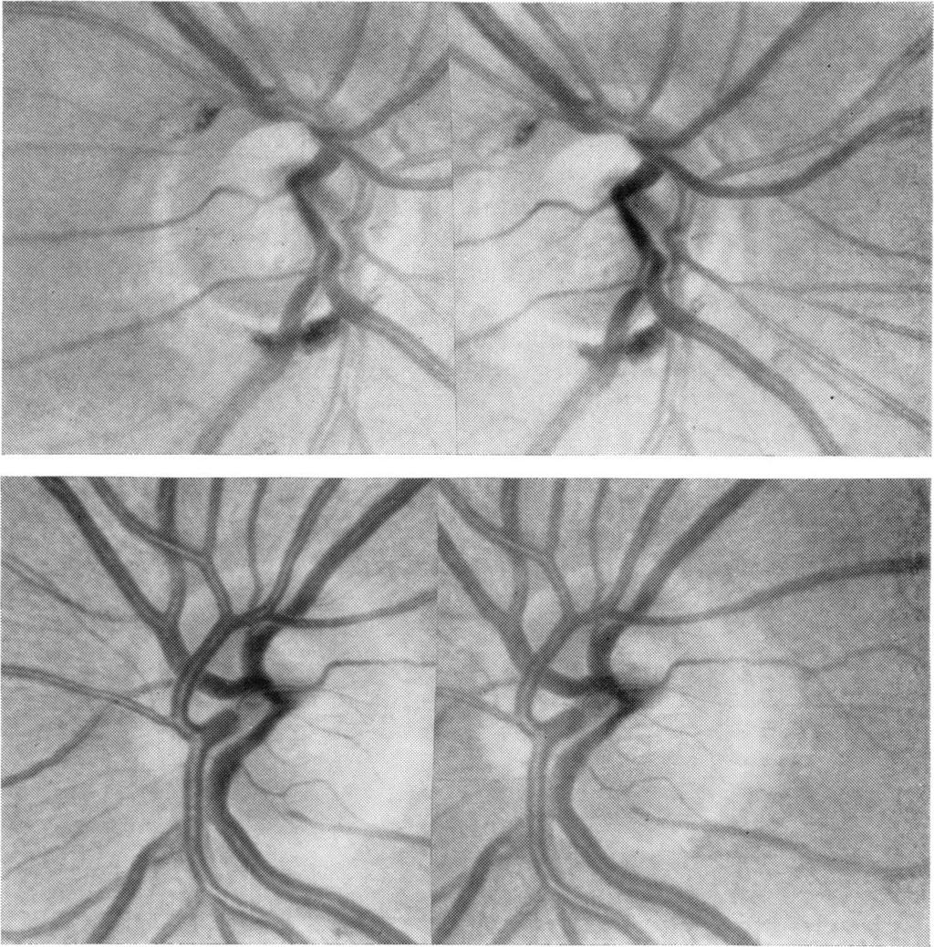 236 ranged from 0 07 to 0 53, while the percentage increase in C/D ratio of the hypertensive eye compared with the normotensive eye ranged from 16% to 170%.