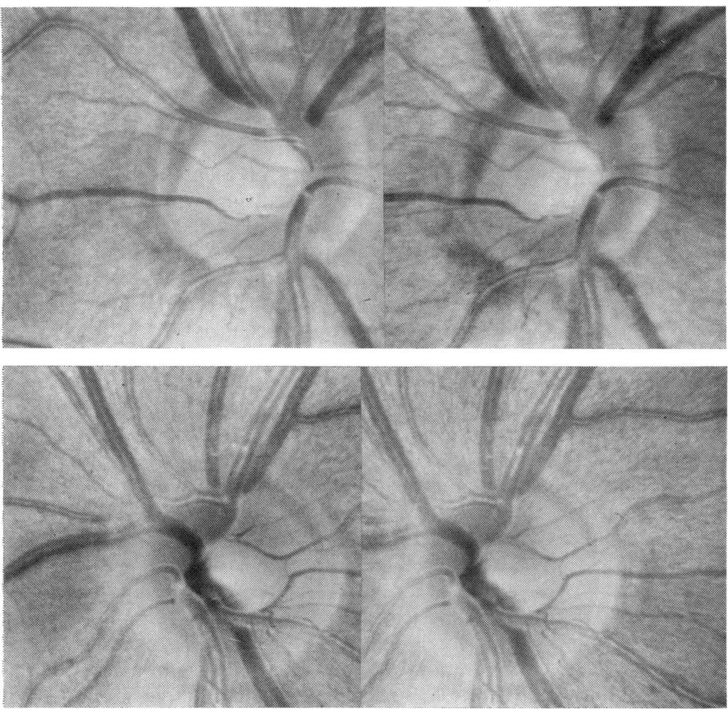 The optic disc in glaucoma. IV Discussion.:.. -~ - S., f ' :: The aim of any monitoring scheme for ocular hypertensive patients should be to use test methods that are accurate and reproducible.