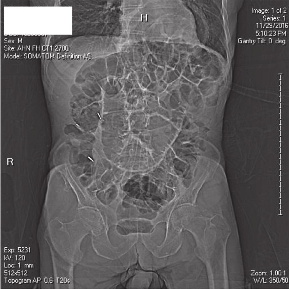 2 Case Reports in Surgery Figure 1: Abdominal X-ray. (a) (b) Figure 2: CT scan.