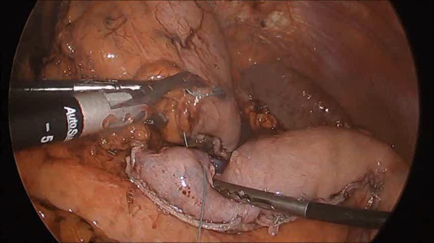 Preparation of the Conduit and Final Inspection 1. Tack Tip to Stapled gastric line 2. Assess crural opening, wider vs.