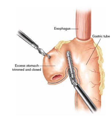 The gastrotomy is closed with Endo GIA stapler Mastery Techniques in