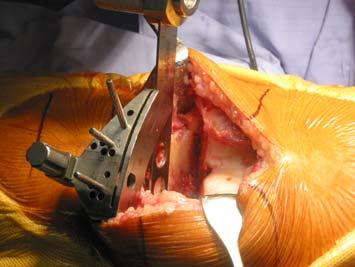 The proximal end of the guide is transfixed with a short pin to center of the tibial plateau.