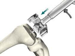 Femoral Preparation Step 3 Anterior, Posterior and Chamfer Cuts Femoral Preparation :1 Cutting Block Fixation > Locate the fixation pegs of the appropriate size Express :1 Cutting Block into the pin