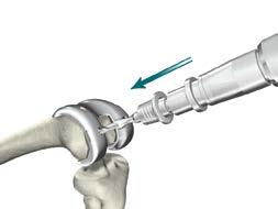 Femoral Preparation Step 5 Femoral Trial Assessment (continued) Femoral Preparation > Cruciate Retaining Knee: Attach the 1/ Peg Drill to the Universal Driver and create the Modular Femoral Distal