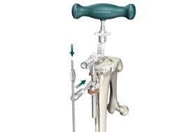 Instrument Bar 651--538 3/8 IM Drill 651--801 Universal Driver ( Tibial Resection Guide shown) Figure 36 651--800 T-Handle Driver 651--516 5/16 IM Rod Tibial Preparation Varus/Valgus Alignment >