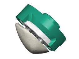 Figure 60 Orienting the Patella Implant to the Native Patella >Ensure all bone debris from patella preparation has been removed so the implant can seat properly.