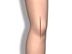 Femoral Preparation Step 1 Distal Resection Femoral Preparation Exposure > Triathlon Total Knee Arthroplasty can be performed through any standard approach.