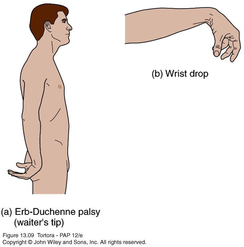 Injuries to the Brachial Plexus Erb-Duchenne palsy (waiter s tip)- loss of sensation