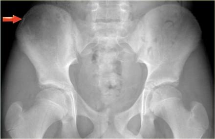 On the left an ill-defined lytic lesion of the right iliac bone in a young patient which can easily be overlooked. Final diagnosis: Ewing's sarcoma.