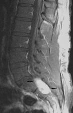 . Sagittal T2-weighted MR image shows high signal intensity mass (arrows) in the sacral canal.