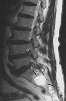 There is erosion (arrows) of the sacral vertebral body.