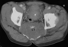 E Fig. 5. 61-year-old man with sacral chordoma.