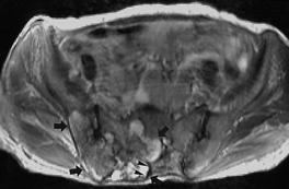 T images of sacral chordomas depict large lytic lesions centered in the midline, and calcification is present in 30 70% of patients.