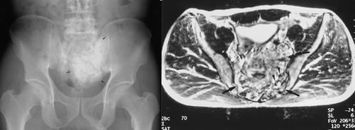 Fig. 9. 46-year-old man with sacral osteosarcoma.. nteroposterior radiograph shows ill-defined mass (arrows) with osseous matrix.