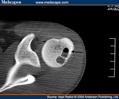 Figure 5. Intraosseous ganglion cyst in a 16 year old.