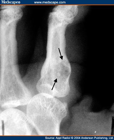 Figure 7. Enchondroma of the proximal phalanx in a 57 yearold woman.