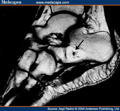Figure 9. Intraosseous lipoma of the calcaneus in a 35 year old man. (A) This lateral radiograph of the ankle shows a geographic lytic lesion in the calcaneus.