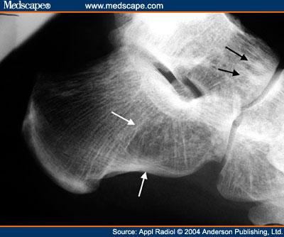 Figure 2. Anterior calcaneal pseudocyst in a 25 year old man. The typical trabecular rarefaction of a pseudocyst can be seen in the anterior calcaneus (white arrows) on this lateral radiograph.