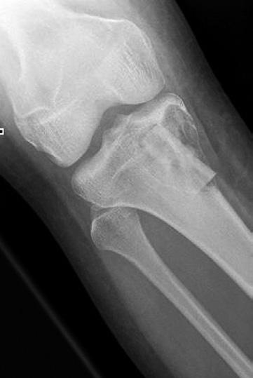 Eradication of the lesion and limiting recurrence while preserving bone integrity and extremity function are the main goals of treatment.
