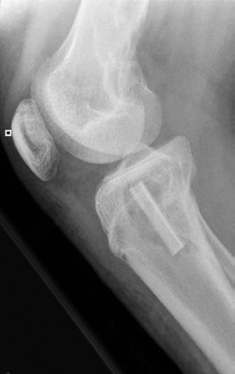 When bone lesions are large (larger than 60 cc) or near joint surfaces and require therapeutic curettage, large structural defects result in the remaining bone, compromising its integrity.