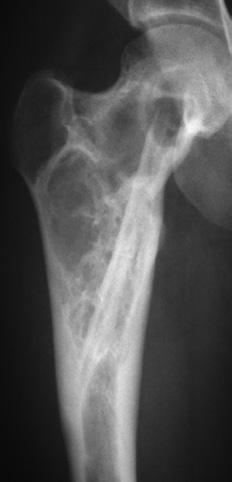 Figure 3: nteroposterior radiograph showing a proximal humerus lesion on presentation (). nteroposterior radiograph at final follow-up showing the reconstruction.