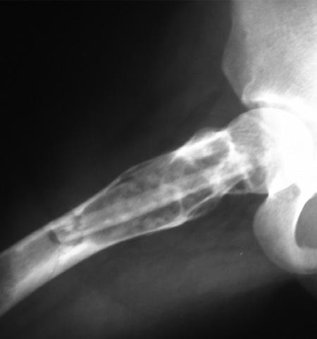 C D Figure 4: Early postoperative anteroposterior () and lateral () radiographs showing proximal femur reconstruction for fibrous dysplasia.