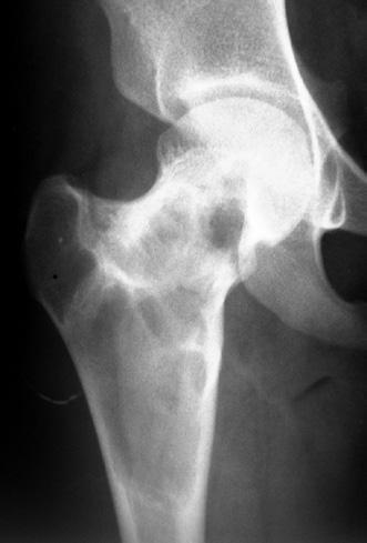 Figure 5: nteroposterior radiograph () and magnetic resonance image () of a 16-year-old girl showing fibrous dysplasia of the proximal femur.