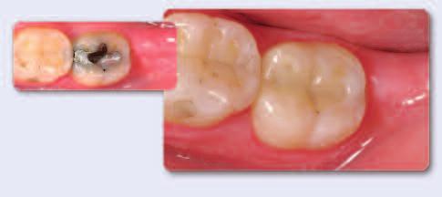 However, the teeth have to be prepared carefully beforehand to establish the prerequisites needed for the correct