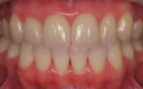 This can be achieved using the Empress Esthetic Veneering Materials (wash pastes,