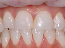 Therefore, various VivaStyle products are available for the whitening of natural teeth.
