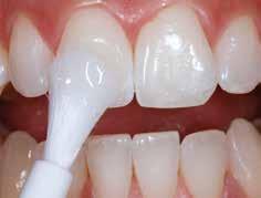 VivaStyle products whiten the teeth, making it easy to provide patients with a bright