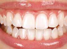 tray. During and after a whitening treatment, local fluoridation of the teeth is advisable.