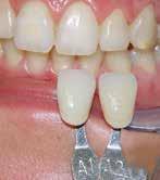 The varnish system does not dissolve in saliva and takes effect within minutes of being applied. After the treatment, it is simply removed with a toothbrush.