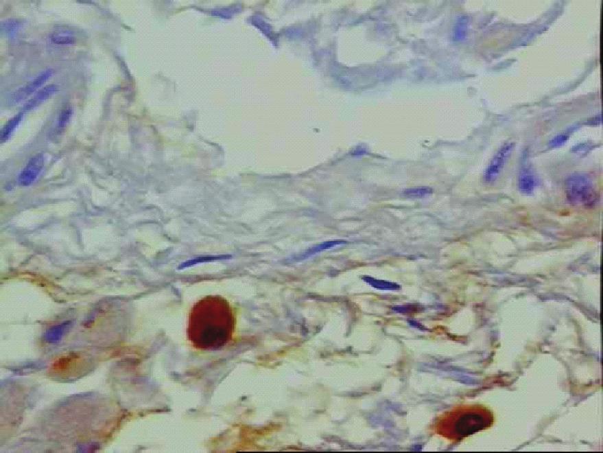 (1,28X); (c) positive IFN-γ staining in the inflammatory exudate (1,28X); (d) positive IL-4