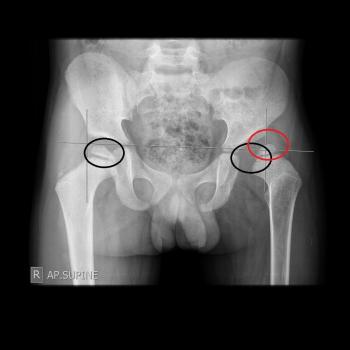 Patient B: Normal positioned right femoral head is noted (black circle). Left smaller femoral head is located superolateral to Hilgenreiner and Perkins lines.